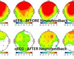 Abb. 5 | Enzephalogramm vor und nach einem Neurofeedback Training